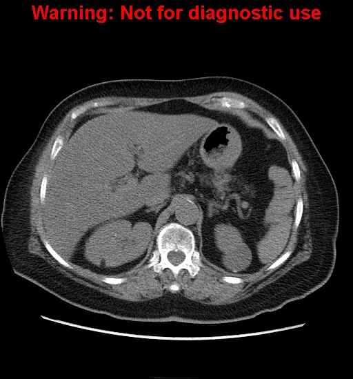 File:Bosniak renal cyst - type II (Radiopaedia 23404-23468 Axial non-contrast 4).jpg
