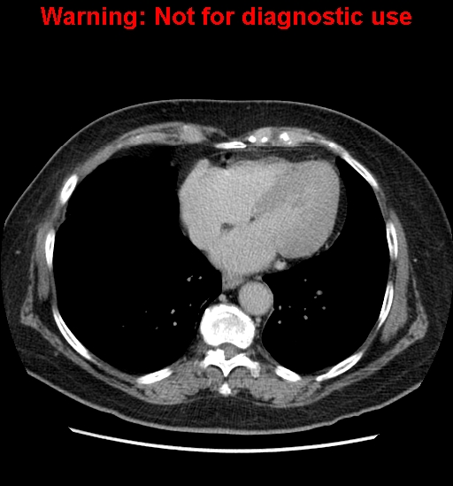File:Bosniak renal cyst - type II (Radiopaedia 23404-23468 F 3).jpg