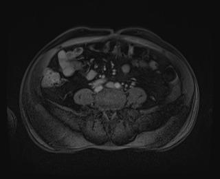 File:Bouveret syndrome (Radiopaedia 61017-68856 Axial T1 C+ fat sat 68).jpg