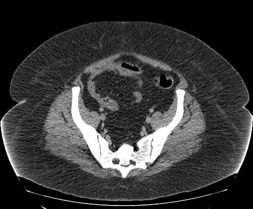 File:Bowel and splenic infarcts in acute lymphocytic leukemia (Radiopaedia 61055-68913 A 101).jpg
