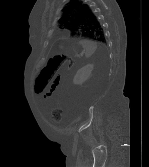 Bowel ischemia secondary to SMA occlusion with extensive portomesenteric venous gas (Radiopaedia 54656-60871 Sagittal bone window 20).jpg