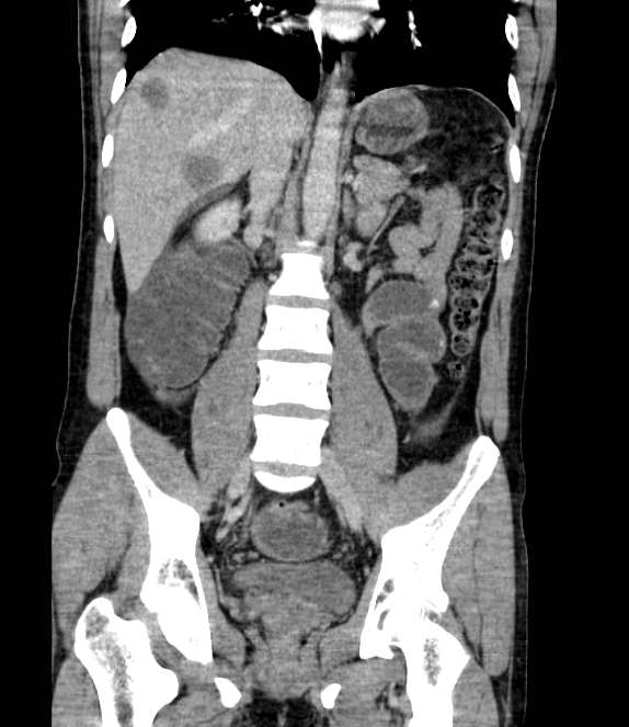 Bowel obstruction from colon carcinoma (Radiopaedia 22995-23028 C 44).jpg