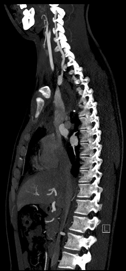 Brachiocephalic trunk pseudoaneurysm (Radiopaedia 70978-81191 C 42).jpg