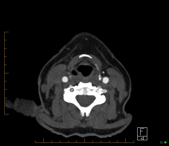 Brachiocephalic trunk stenosis (Radiopaedia 87242-103519 A 100).jpg