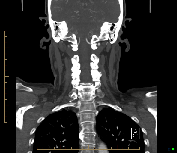Brachiocephalic trunk stenosis (Radiopaedia 87242-103519 B 49).jpg