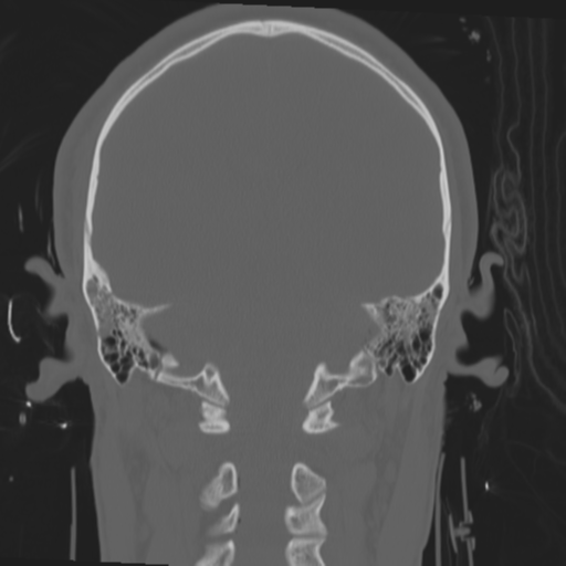 File:Brain contusions, internal carotid artery dissection and base of skull fracture (Radiopaedia 34089-35339 Coronal bone window 46).png