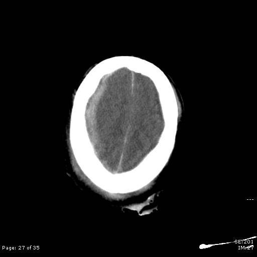 File:Brain death after motor vehicle collision (Radiopaedia 88470-105114 Axial non-contrast 27).jpg
