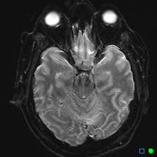 File:Brain death on MRI and CT angiography (Radiopaedia 42560-45689 Axial ADC 13).jpg