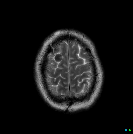 File:Brain death on MRI and CT angiography (Radiopaedia 42560-45689 Axial T2 28).jpg