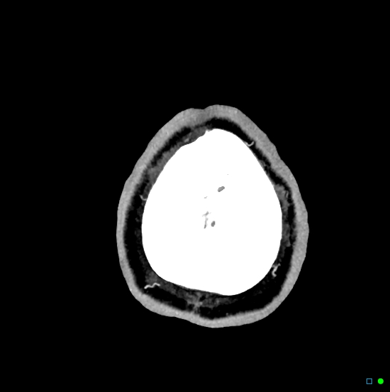 Brain death on MRI and CT angiography (Radiopaedia 42560-45841 B 4).jpg