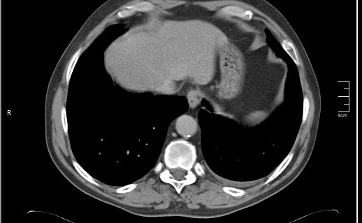File:Brain metastases from squamocellular lung cancer (Radiopaedia 56515-63219 B 52).jpg