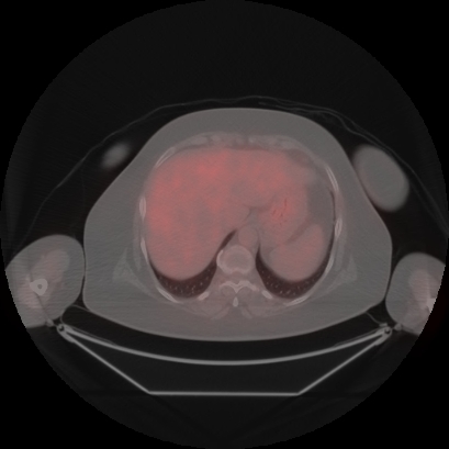 Brain metastasis (Radiopaedia 89847-106962 Axial lung window 55).jpg