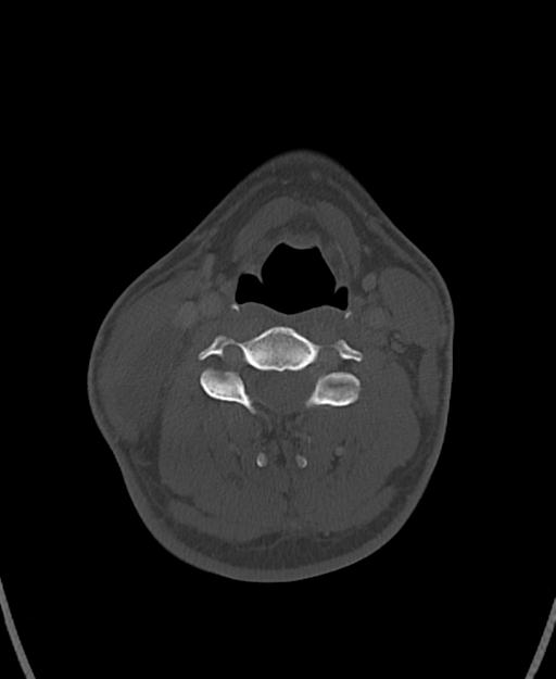 Branchial cleft cyst (Radiopaedia 31167-31875 Axial bone window 41).jpg