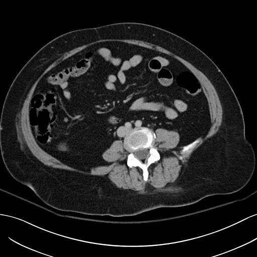 Breast carcinoma with pathological hip fracture (Radiopaedia 60314-67974 B 41).jpg