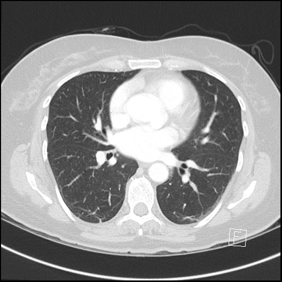 File:Breast metastases from renal cell cancer (Radiopaedia 79220-92225 Axial lung window 47).jpg