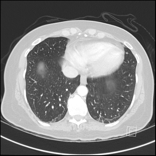 Breast metastases from renal cell cancer (Radiopaedia 79220-92225 Axial lung window 66).jpg