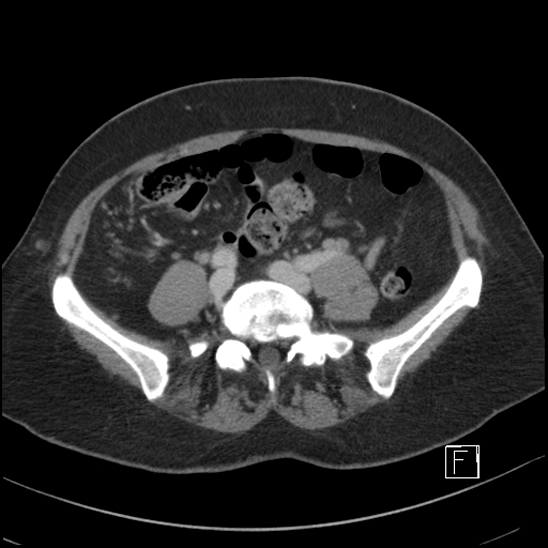 Breast metastases from renal cell cancer (Radiopaedia 79220-92225 C 76).jpg