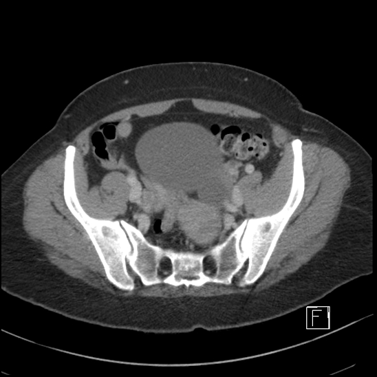 File:Breast metastases from renal cell cancer (Radiopaedia 79220-92225 C 91).jpg