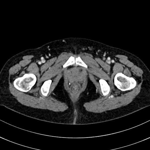 File:Broad ligament hernia (Radiopaedia 84802-100276 A 4).jpg