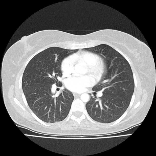 Bronchial atresia (Radiopaedia 22965-22992 Axial lung window 25).jpg