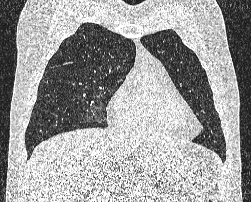 File:Bronchial atresia (Radiopaedia 58271-65417 Coronal lung window 14).jpg