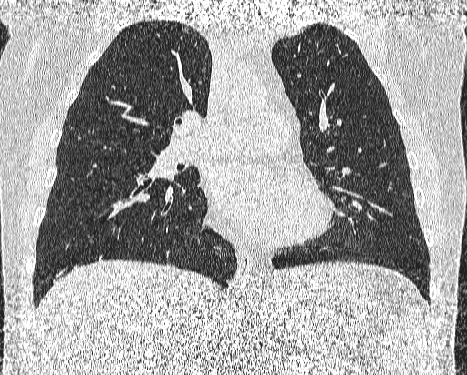 Bronchial atresia (Radiopaedia 58271-65417 Coronal lung window 25).jpg
