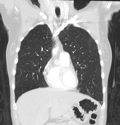 File:Bronchial atresia (Radiopaedia 73677-84470 Coronal lung window 10).jpg