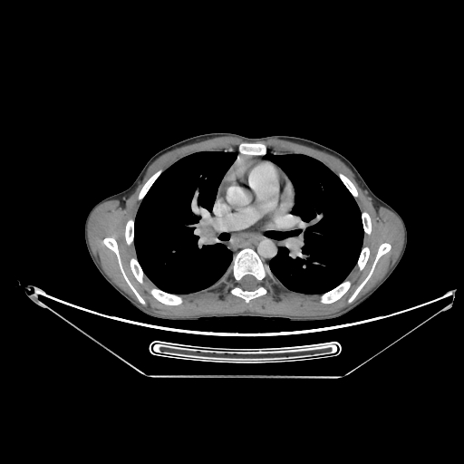 Bronchial carcinoid tumor (Radiopaedia 57187-64090 A 33).jpg