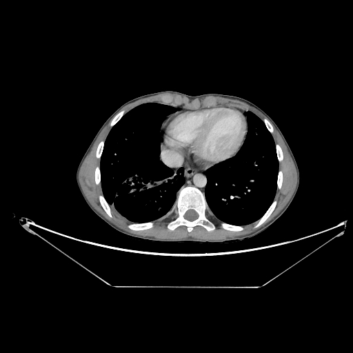 Bronchial carcinoid tumor (Radiopaedia 57187-64090 A 59).jpg