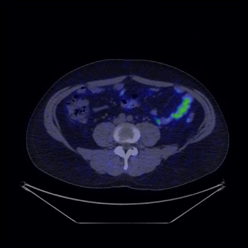 Bronchial carcinoid tumor (Radiopaedia 67377-76765 68Ga-DOTATATE PET-CT 58).jpg