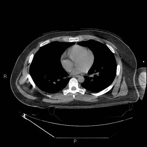 Bronchial carcinoid tumor (Radiopaedia 78272-90870 Axial non-contrast 63).jpg