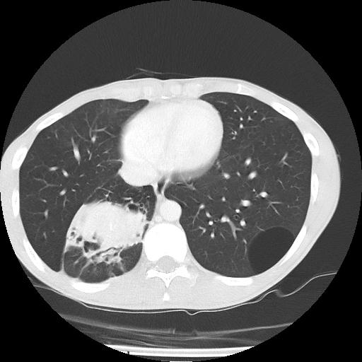 Bronchial carcinoid tumor causing right lower lobe collapse (Radiopaedia 83495-98594 Axial lung window 39).jpg