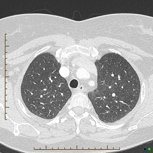 Bronchial diverticula (Radiopaedia 79512-92676 Axial lung window 37).jpg