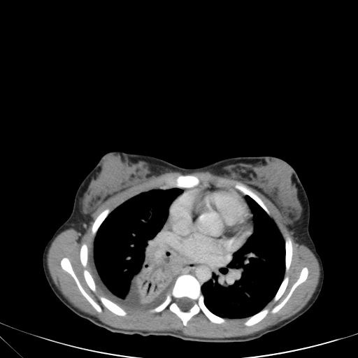 Bronchial mucoepidermoid carcinoma (Radiopaedia 57023-63895 Axial 55).jpg