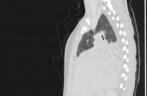 Bronchial mucoepidermoid carcinoma (Radiopaedia 57023-63895 Sagittal lung window 45).jpg