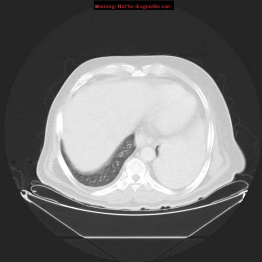 File:Bronchioloalveolar carcinoma (Radiopaedia 9272-9955 Axial lung window 25).jpg