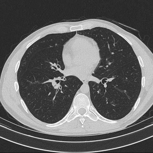 Bronchocele (Radiopaedia 60676-68429 Axial lung window 41).jpg
