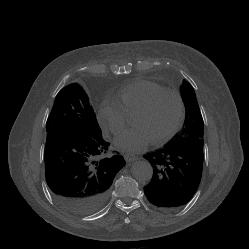 Bronchogenic carcinoma with metastatic lymphadenopathy (Radiopaedia 37671-39569 Axial bone window 36).jpg
