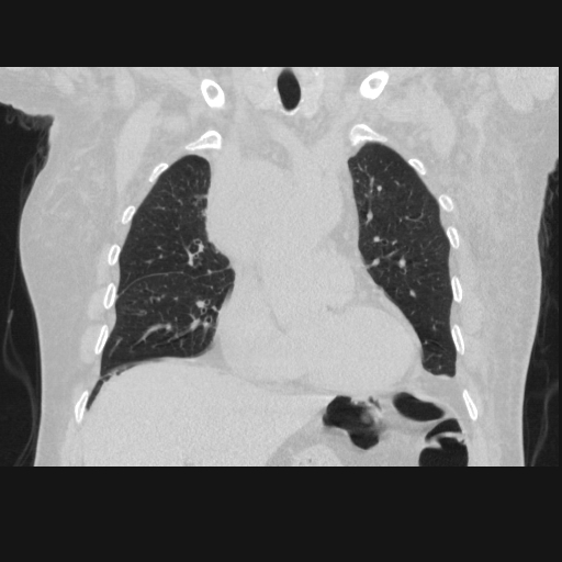 File:Bronchogenic carcinoma with metastatic lymphadenopathy (Radiopaedia 37671-39569 Coronal lung window 17).jpg