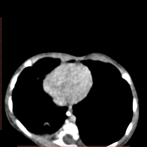 Bronchogenic cyst (Radiopaedia 78599-91409 B 145).jpg