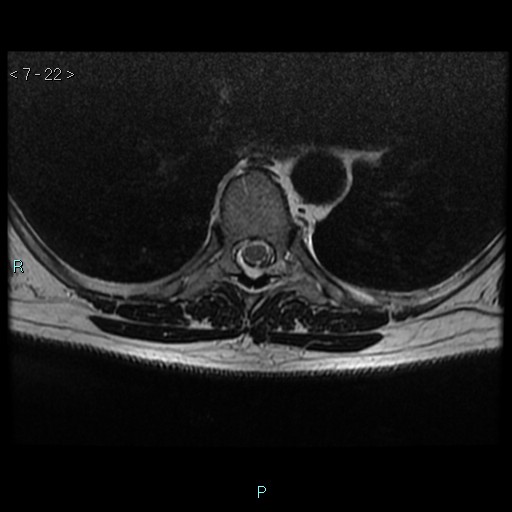 File:Bronchogenic cyst - posterior mediastinal (Radiopaedia 43885-47365 Axial T2 22).jpg