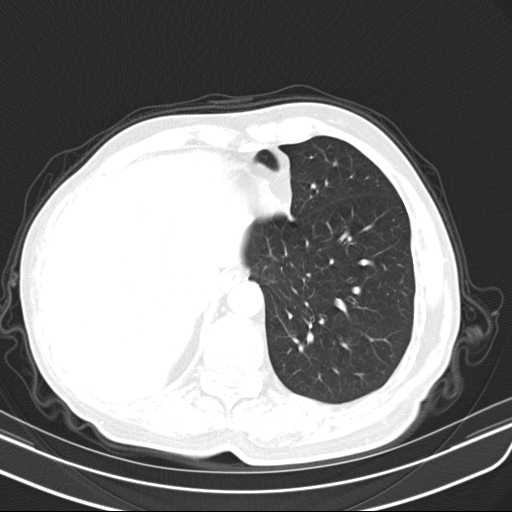 Bronchopleural fistula - postoperative complication (Radiopaedia 21020-20947 Axial lung window 45).jpg
