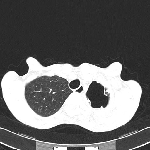 Bronchopleural fistula secondary to tuberculosis (Radiopaedia 20415-20322 Axial lung window 13).jpg