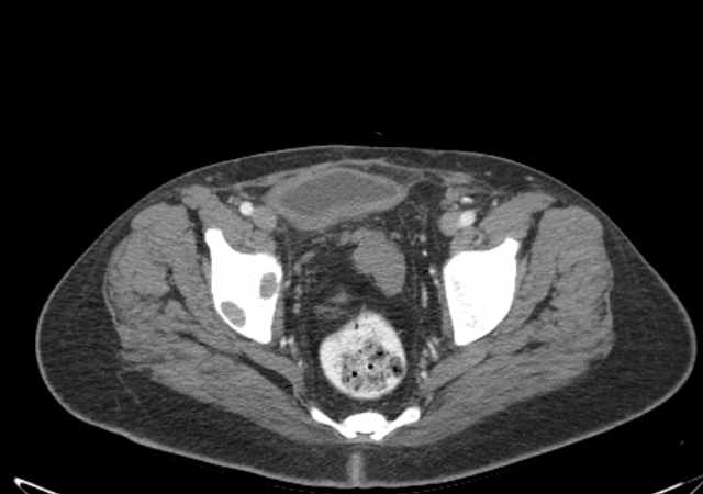 File:Brown tumors compressing the spinal cord (Radiopaedia 68442-77988 E 112).jpg