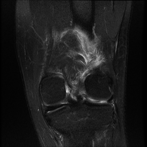 File:Bucket-handle meniscus tear (Radiopaedia 65700-74809 Coronal T2 fat sat 7).jpg