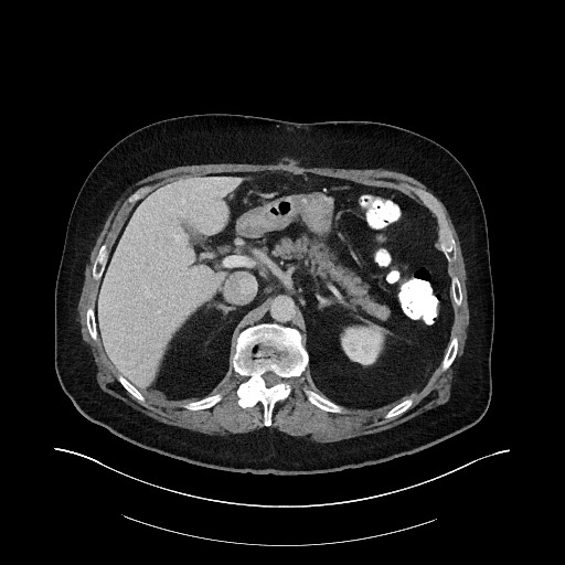 Buried bumper syndrome - gastrostomy tube (Radiopaedia 63843-72575 A 16).jpg