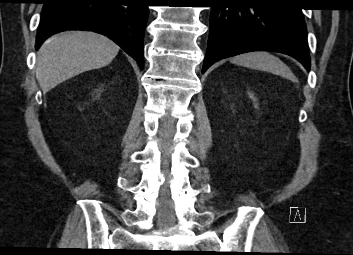 Buried bumper syndrome - gastrostomy tube (Radiopaedia 63843-72577 Coronal Inject 104).jpg