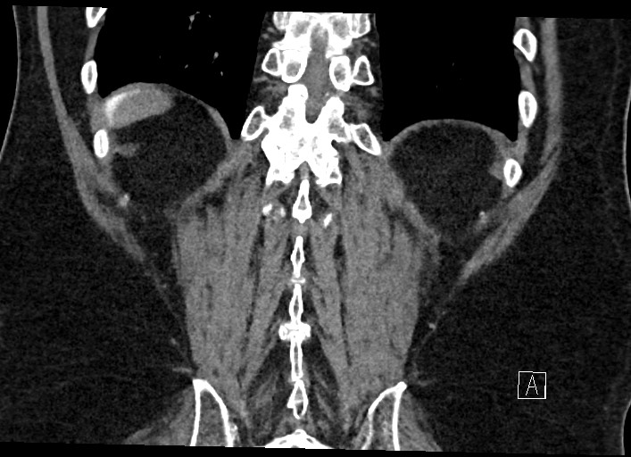 Buried bumper syndrome - gastrostomy tube (Radiopaedia 63843-72577 Coronal Inject 118).jpg