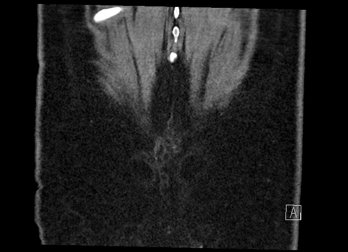 Buried bumper syndrome - gastrostomy tube (Radiopaedia 63843-72577 Coronal Inject 136).jpg