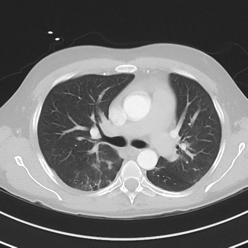 Burkitt lymphoma (Radiopaedia 34686-36121 Axial lung window 21).png
